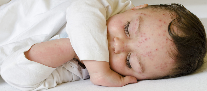 Baby With Chicken Pox